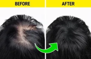 Unlock Secrets to Regrow Lost Hair
