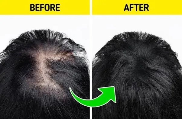Unlock Secrets to Regrow Lost Hair